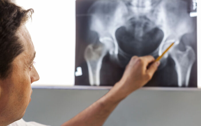 osteoporosi