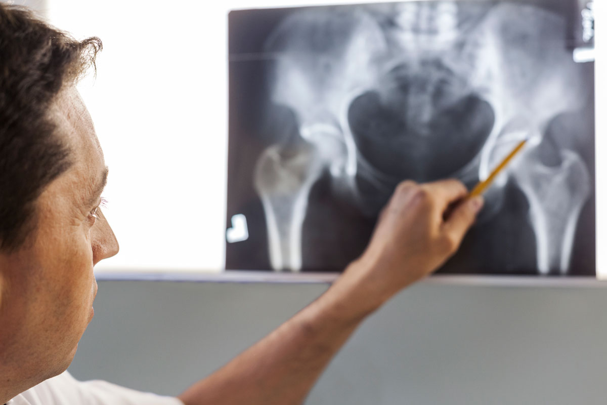 osteoporosi